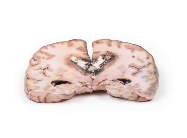 (MP2003) Glioma Grade 3-4, causing papilloedema