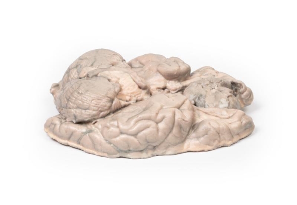(MP2004) Meningioma
