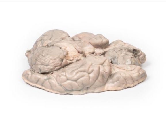 https://www.jayakelana.id/uploads/product/-mp2004-meningioma-6961502fd874c81_cover.jpg