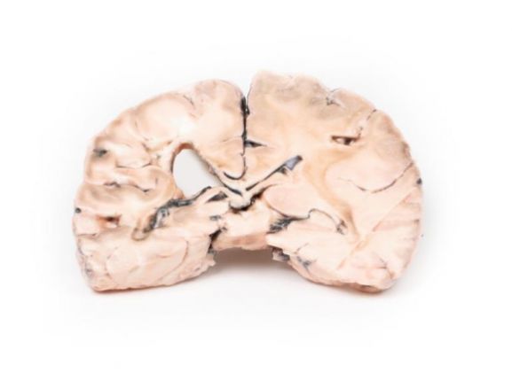 https://www.jayakelana.id/uploads/product/-mp2005-left-cerebral-infarct-79391d7c5ffe427_cover.jpg