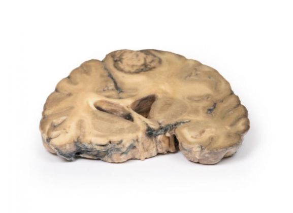 https://www.jayakelana.id/uploads/product/-mp2007-metastatic-adenocarcinoma-in-681531e669e5ea8_cover.jpg